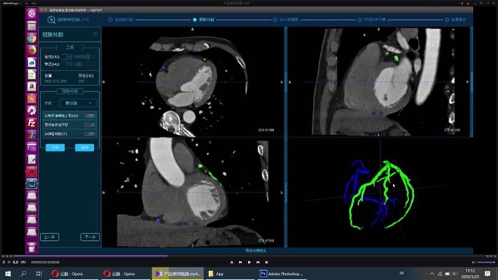 图为冠脉血流储备分数计算软件成像界面。(石景山区市场监管局供图) 图为冠脉血流储备分数计算软件成像界面。(石景山区市场监管局供图)