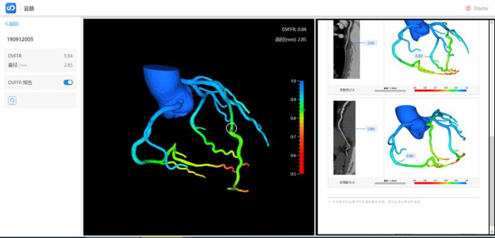 图为冠脉血流储备分数计算软件成像界面。(石景山区市场监管局供图)2 图为冠脉血流储备分数计算软件成像界面。(石景山区市场监管局供图)2
