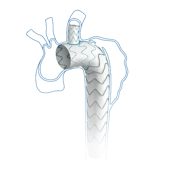 Castor®分支型主动脉覆膜支架及输送系统-1