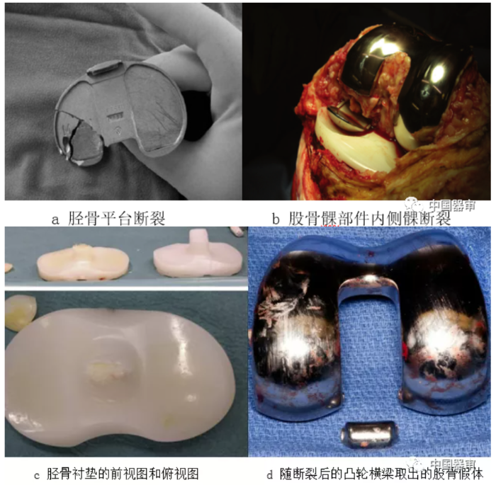 图2 全膝关节假体部件失效模式及举例