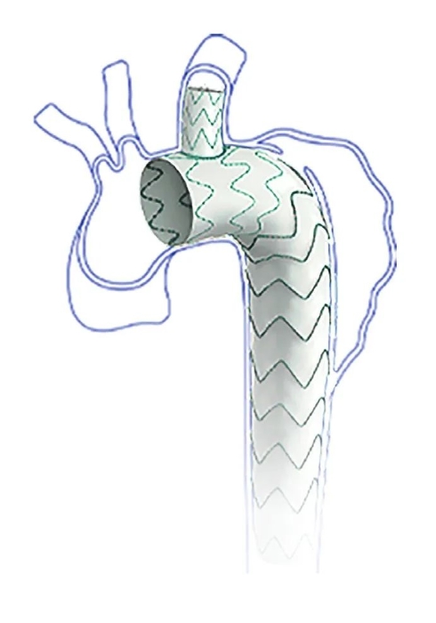 图为Castor分支型主动脉覆膜支架系统。