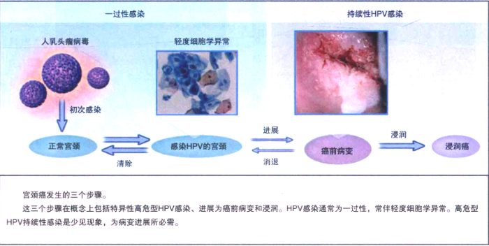 图1 正常宫颈感染高危型HPV后进展到宫颈癌的模式图