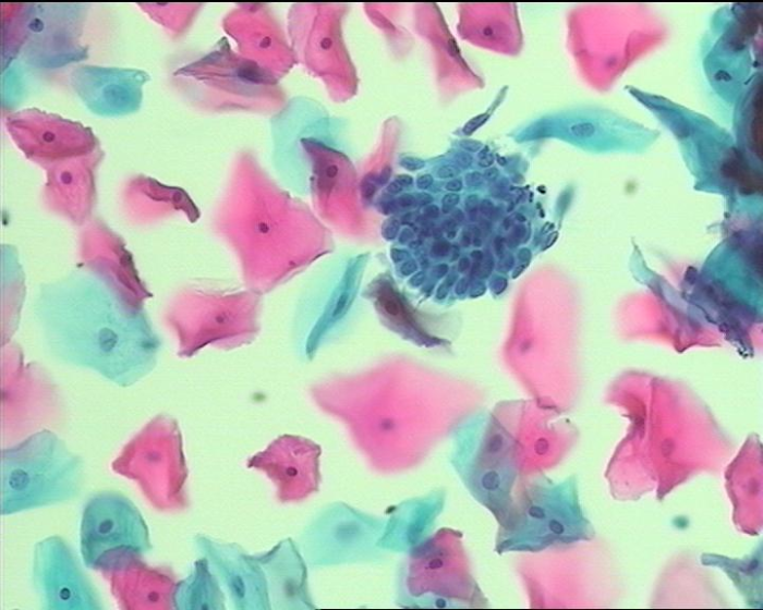 图2 正常宫颈鳞状上皮细胞与腺细胞
