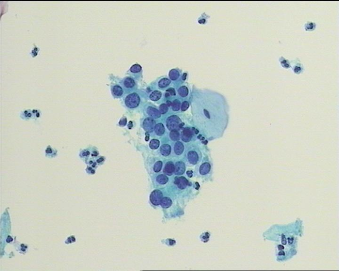图5 非典型鳞状细胞不除外高度鳞状上皮内病变细胞（ASC-H）