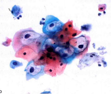 图6低度鱗状上皮内病变细胞（LSIL）