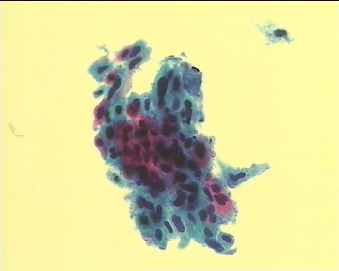 图7 高度鱗状上皮内病变细胞（HSIL）