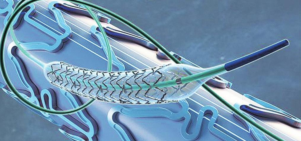 上市药物洗脱支架技术类型大盘点