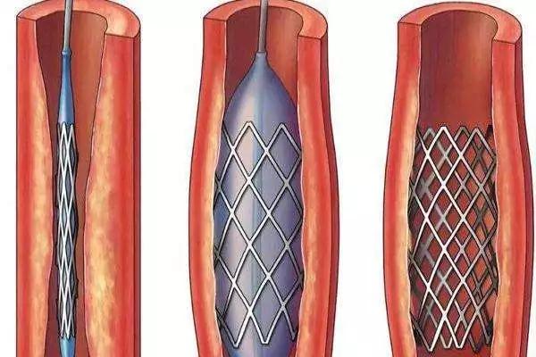 哪些人适合做心脏支架?术后还能做磁共振吗?--中国食品药品网