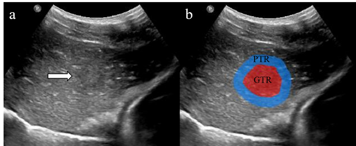 灰阶超声肿瘤切面中(a)肿瘤(gtr)与(b)瘤周区域(ptr),以及全肿瘤怯蝌