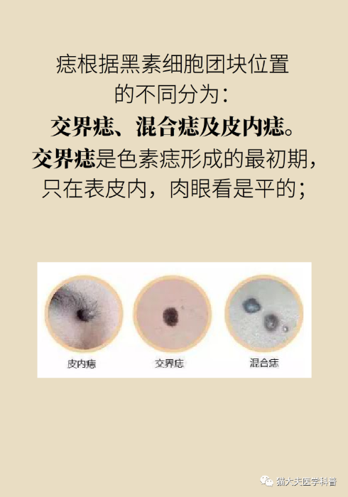 点痣有风险吗